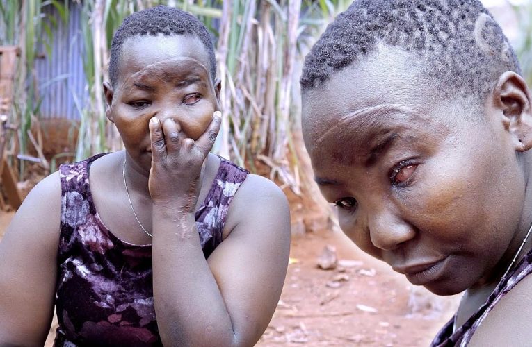 Video: How my jealous husband removed my eye and cut off my fingers – Woman narrates