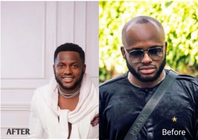 Nigerian Comedian Undergoes Hair Transplant, Shares Before And After Picture